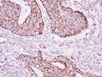 Immunohistochemistry-Paraffin: CGI-16 Antibody [NBP2-15872] - Immunohistochemical analysis of paraffin-embedded Colon ca, using antibody at 1:250 dilution.