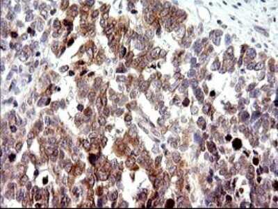 Immunohistochemistry: CHAC1 Antibody (OTI1E2) [NBP2-46273] - Analysis of Adenocarcinoma of Human colon tissue. (Heat-induced epitope retrieval by 10mM citric buffer, pH6.0, 120C for 3min)