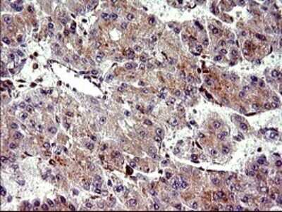 Immunohistochemistry: CHAC1 Antibody (OTI1E2) [NBP2-46273] - Analysis of Carcinoma of Human liver tissue.(Heat-induced epitope retrieval by 10mM citric buffer, pH6.0, 120C for 3min)