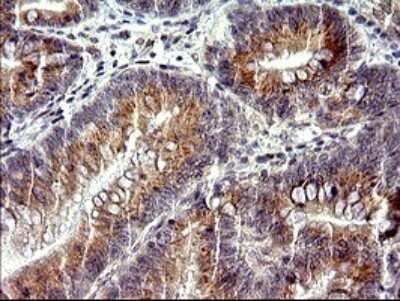 Immunohistochemistry: CHAC1 Antibody (OTI1E2) [NBP2-46273] - Analysis of Carcinoma of Human pancreas tissue. (Heat-induced epitope retrieval by 10mM citric buffer, pH6.0, 120C for 3min)