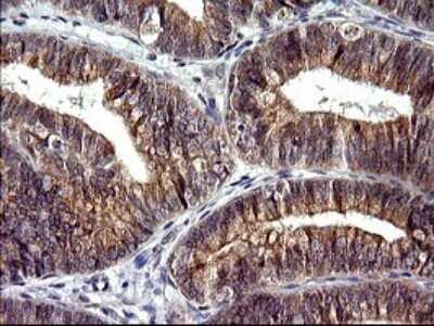 Immunohistochemistry: CHAC1 Antibody (OTI1E2) [NBP2-46273] - Analysis of Adenocarcinoma of Human endometrium tissue. (Heat-induced epitope retrieval by 10mM citric buffer, pH6.0, 120C for 3min)