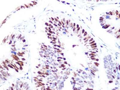 Immunohistochemistry-Paraffin: CHAF1B Antibody (7N0I2) [NBP3-16545] - Immunohistochemistry of paraffin-embedded human colon carcinoma using CHAF1B Rabbit mAb (NBP3-16545) at dilution of 1:100 (40x lens).Perform microwave antigen retrieval with 10 mM PBS buffer pH 7.2 before commencing with IHC staining protocol.