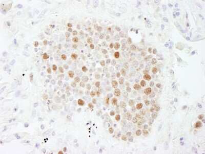 <b>Independent Antibodies Validation, Biological Strategies Validation, Orthogonal Strategies Validation and Expression of Tagged Proteins Validation.</b>Immunohistochemistry: CHAF1B Antibody [NB100-57523] - Sample: FFPE section of human small cell lung cancer. Antibody: Affinity purified rabbit anti-CAF-1 p60 used at a dilution of 1:200 (1ug/ml). Detection: DAB staining using Immunohistochemistry Accessory Kit.