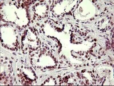 Immunohistochemistry: CHAF1B Antibody (OTI4F7) - Azide and BSA Free [NBP2-71366] - Analysis of Carcinoma of Human prostate tissue. (Heat-induced epitope retrieval by 10mM citric buffer, pH6.0, 120C for 3min)