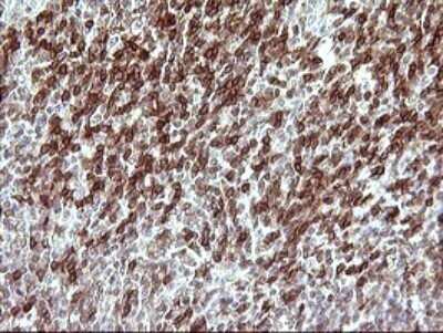 Immunohistochemistry: CHAF1B Antibody (OTI4F7) - Azide and BSA Free [NBP2-71366] - Analysis of Human lymphoma tissue. (Heat-induced epitope retrieval by 10mM citric buffer, pH6.0, 120C for 3min)