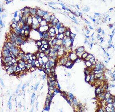 Immunohistochemistry-Paraffin: CHCHD2 Antibody [NBP2-92335] - Human colon carcinoma using [KO Validated] CHCHD2 RabbitpAb (A16645) at dilution of 1:100 (40x lens).
