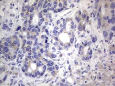 Immunohistochemistry: CHCHD3 Antibody (7G4) [NBP2-46281] - Analysis of Carcinoma of Human pancreas tissue.