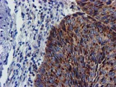 Immunohistochemistry: CHCHD5 Antibody (OTI3H3) - Azide and BSA Free [NBP2-72289] - Staining of paraffin-embedded Carcinoma of Human bladder tissue using anti-CHCHD5 mouse monoclonal antibody.