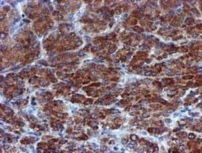Immunohistochemistry: CHCHD5 Antibody (OTI3H3) - Azide and BSA Free [NBP2-72289] - Staining of paraffin-embedded Carcinoma of Human liver tissue using anti-CHCHD5 mouse monoclonal antibody.