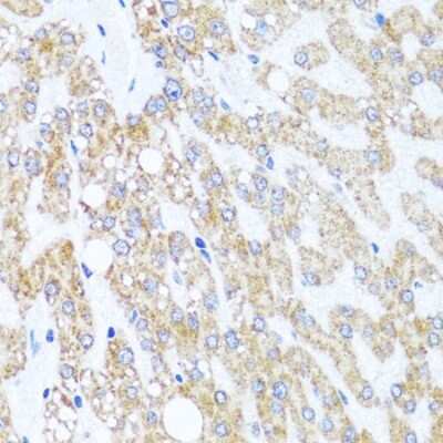 Immunohistochemistry-Paraffin: CHD1 Antibody [NBP3-02966] - Human liver damage using CHD1 antibody (NBP3-02966) at dilution of 1:100 (40x lens).