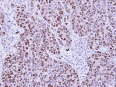 Immunohistochemistry-Paraffin: CHD2 Antibody [NBP1-33428] - Paraffin-embedded SW480 Xenograft, using antibody at 1:100 dilution.