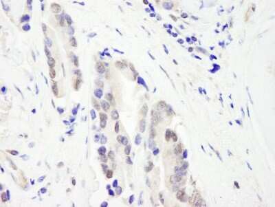 <b>Independent Antibodies Validation and Biological Strategies Validation.</b>Immunohistochemistry-Paraffin: CHD3 Antibody [NB100-60412] -  Section of human prostate carcinoma. Antibody: Affinity purified rabbit anti-CHD3  used at a dilution of 1:1,000 (1ug/ml). Detection: DAB