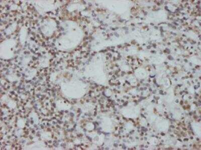 Immunohistochemistry-Paraffin: CHFR Antibody (1H3-A12) [H00055743-M01] - Immunoperoxidase of monoclonal antibody to CHFR on formalin-fixed paraffin-embedded human ovary, clear cell carcinoma tissue.