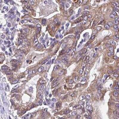 Immunohistochemistry: AMCase/CHIA Antibody [NBP2-32440] -  Staining of stomach cancer.