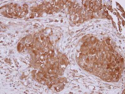 Immunohistochemistry-Paraffin: CHIP Antibody [NBP2-15882] - Immunohistochemical analysis of paraffin-embedded Breast ca, using antibody at 1:500 dilution.