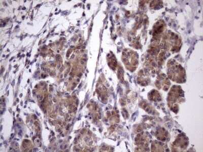 Immunohistochemistry: CHMP5 Antibody (5C7) [NBP2-46283] - Analysis of Carcinoma of Human pancreas tissue. (Heat-induced epitope retrieval by Tris-EDTA, pH8.0)