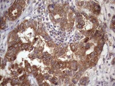 Immunohistochemistry: CHMP5 Antibody (5C7) [NBP2-46283] - Analysis of Adenocarcinoma of Human endometrium tissue. (Heat-induced epitope retrieval by Tris-EDTA, pH8.0)