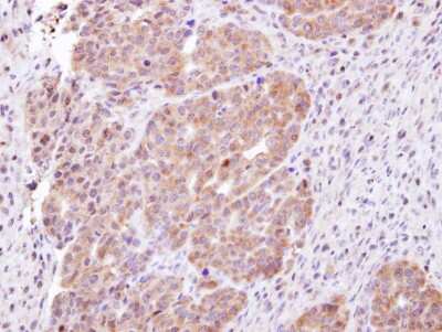 Immunohistochemistry-Paraffin: CHMP5 Antibody [NBP1-32597] - NCIN87 xenograft, using CHMP5 antibody at 1:100 dilution. Antigen Retrieval: Trilogy™ (EDTA based, pH 8.0) buffer, 15min.