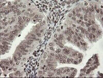 Immunohistochemistry: CHN 1 Antibody (OTI2G6) - Azide and BSA Free [NBP2-70411] - Analysis of Adenocarcinoma of Human endometrium tissue.