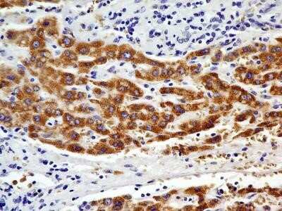 Immunohistochemistry: CHREBP Antibody (2D9NB) - Azide and BSA Free [NBP2-80669] - Analysis of a FFPE tissue section of human hepatocellular carcinoma using 1:200 dilution of CHREBP antibody (clone 2D9NB). The antibody generated a diffused to punctate staining pattern in the cytoplasm of cancer cells. Some cells depicted nuclear positiv