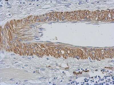 Immunohistochemistry-Paraffin: Carbohydrate Sulfotransferase 15/CHST15 Antibody [NBP2-15896] - Human gastric cancer, using CHST15 antibody at 1:500 dilution. Antigen Retrieval: Trilogy™ (EDTA based, pH 8.0) buffer, 15min. 
