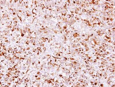 Immunohistochemistry-Paraffin: CHSY1 Antibody [NBP2-15899] - ES2 xenograft, using CHSY1 antibody at 1:100 dilution.  Antigen Retrieval: Citrate buffer, pH 6.0, 15 min. 