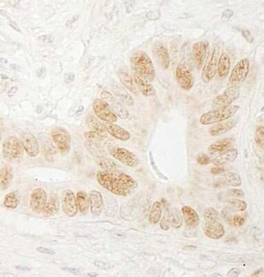 <b>Independent Antibodies Validation and Biological Strategies Validation.</b>Immunohistochemistry-Paraffin: CHTF18 Antibody [NBP1-03346] - Human stomach carcinoma. Antibody used at a dilution of 1:200 (1ug/ml).