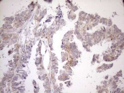 Immunohistochemistry: CIAPIN1 Antibody (5A6) [NBP2-46291] - Analysis of Adenocarcinoma of Human ovary tissue. (Heat-induced epitope retrieval by 1mM EDTA in 10mM Tris buffer (pH8.5) at 120C for 3 min)