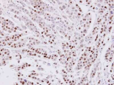 Immunohistochemistry-Paraffin: CIP29 Antibody [NBP1-32511] - Paraffin-embedded MDAMB-468 xenograft, using antibody at 1:100 dilution.