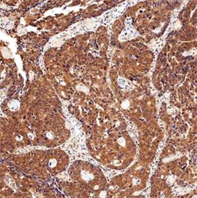 Immunohistochemistry-Paraffin: CIP2A Antibody (2G10) - Azide and BSA Free [NBP2-80670] - IHC analysis of formalin fixed paraffin-embedded (FFPE) human colon cancer using CIP2A antibody at 1:200 on a Bond Rx autostainer (Leica Biosystems). The assay involved 20 minutes of heat induced antigen retrieval (HIER) using 10mM sodium citrate buffer (