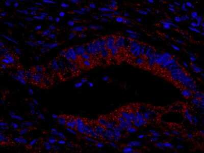 Immunohistochemistry: CIP2A Antibody [NB100-74663] - Section of human colon carcinoma. Antibody: Affinity purified rabbit anti-CIP2A used at a dilution of 1:100. Detection: Red-fluorescent goat anti-rabbit IgG highly cross-adsorbed Antibody used at a dilution of 1:100.