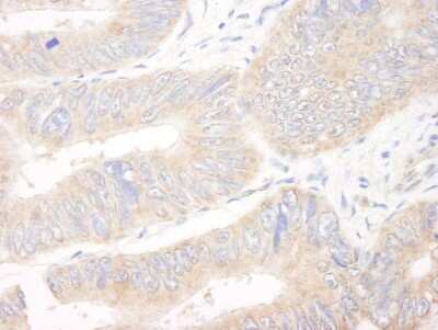 <b>Biological Strategies Validation. </b>Immunohistochemistry-Paraffin: CIP2A Antibody [NB100-68264] - Human colon carcinoma. Antibody used at a dilution of 1:200 (1ug/ml).