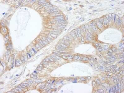 Immunohistochemistry-Paraffin: CIP2A Antibody [NB100-74663] - Section of human colon carcinoma. Antibody: Affinity purified rabbit anti-CIP2A used at a dilution of 1:250. Detection: DAB