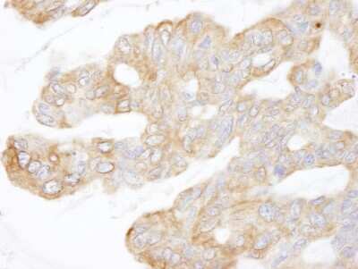 Immunohistochemistry-Paraffin: CIP2A Antibody [NB100-74663] - Section of human ovarian carcinoma. Antibody: Affinity purified rabbit anti-CIP2A  used at a dilution of 1:250. Detection: DAB