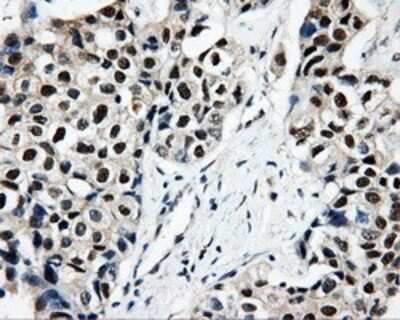 Immunohistochemistry: CISD1 Antibody (OTI4G3) - Azide and BSA Free [NBP2-72026] - Staining of paraffin-embedded Adenocarcinoma of breast tissue using anti-CISD1 mouse monoclonal antibody.