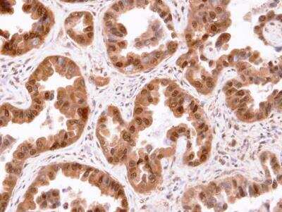 Immunohistochemistry-Paraffin: CISH/CIS-1 Antibody [NBP1-30943] - Human lung cancer, using CIS antibody at 1:100 dilution. Antigen Retrieval: Trilogy™ (EDTA based, pH 8.0) buffer, 15min. 