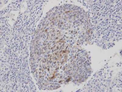 Immunohistochemistry-Paraffin: CLCA1 Antibody [NBP1-31129] - Paraffin-embedded gastric CA, using antibody at 1:100 dilution.