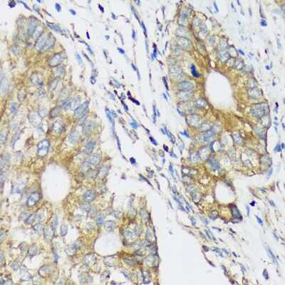 Immunohistochemistry-Paraffin: CLCC1 Antibody [NBP2-92369] - Immunohistochemistry of paraffin-embedded Human colon carcinoma using CLCC1 Rabbit pAb (NBP2-92369) at dilution of 1:100 (40x lens). Perform microwave antigen retrieval with 10 mM PBS buffer pH 7.2 before commencing with IHC staining protocol.