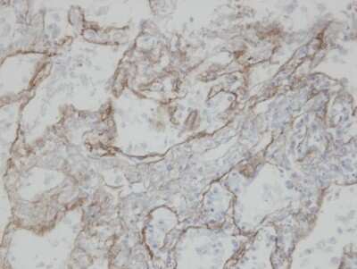 Immunohistochemistry-Paraffin: CLIC3 Antibody [NBP1-31438] - Paraffin-embedded T(IV)(lung CA), using antibody at 1:100 dilution.