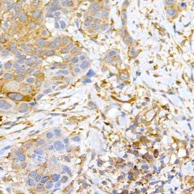 Immunohistochemistry-Paraffin: CLIC4 Antibody [NBP2-92908] - Human esophageal cancer using CLIC4 Rabbit pAb at dilution of 1:50 (40x lens).Perform high pressure antigen retrieval with 10 mM citrate buffer pH 6.0 before commencing with IHC staining protocol.