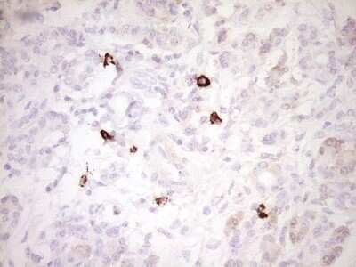 Immunohistochemistry: CLOCK Antibody (OTI2H7) - Azide and BSA Free [NBP2-71479] - Analysis of Carcinoma of Human pancreas tissue. (Heat-induced epitope retrieval by 1 mM EDTA in 10mM Tris, pH8.5, 120C for 3min)