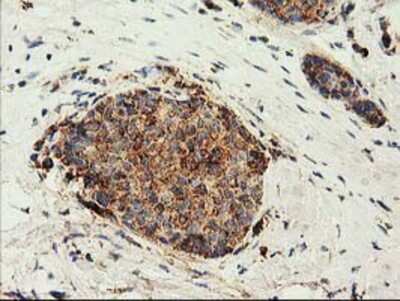 Immunohistochemistry-Paraffin: CLPP Antibody (1F6) [NBP2-03323] - Staining of paraffin-embedded Adenocarcinoma of Human breast tissue using anti-CLPP mouse monoclonal antibody.