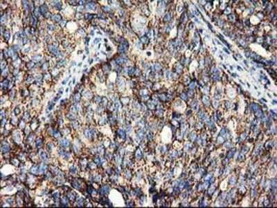 Immunohistochemistry-Paraffin: CLPP Antibody (1F6) [NBP2-03323] - Staining of paraffin-embedded Adenocarcinoma of Human ovary tissue using anti-CLPP mouse monoclonal antibody.