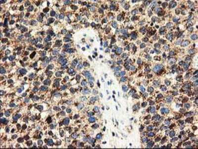 Immunohistochemistry-Paraffin: CLPP Antibody (OTI1F6) [NBP2-03323] - CLPP Antibody (1F6) [NBP2-03323] - Staining of paraffin-embedded Carcinoma of Human bladder tissue using anti-CLPP mouse monoclonal antibody.CLPP Antibody (OTI1F6)