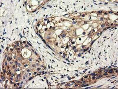 Immunohistochemistry-Paraffin: CLPP Antibody (1F6) [NBP2-03323] - Staining of paraffin-embedded Carcinoma of Human pancreas tissue using anti-CLPP mouse monoclonal antibody.