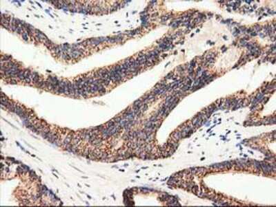 Immunohistochemistry-Paraffin: CLPP Antibody (1F6) [NBP2-03323] - Staining of paraffin-embedded Carcinoma of Human prostate tissue using anti-CLPP mouse monoclonal antibody.