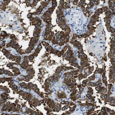 Immunohistochemistry-Paraffin: CLPTM1L Antibody [NBP1-84378] - Staining of human lung cancer, adenocarcinoma shows strong positivity.