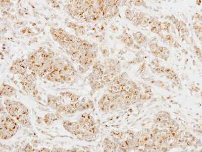 Immunohistochemistry-Paraffin: CLUL1 Antibody [NBP2-15921] - Immunohistochemical analysis of paraffin-embedded Breast ca, using antibody at 1:250 dilution.