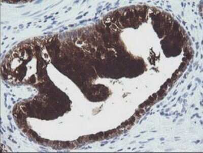 Immunohistochemistry: CMP kinase Antibody (OTI1A1) - Azide and BSA Free [NBP2-71947] - Analysis of Carcinoma of Human prostate tissue.