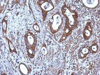 Immunohistochemistry-Paraffin: CNDP1 Antibody [NBP2-15925] - Immunohistochemical analysis of paraffin-embedded Gastric ca, using antibody at 1:500 dilution.